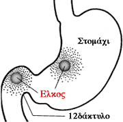 Πεπτικό έλκος: μήπως είναι λοίμωξη;