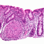 Νόσος Crohn