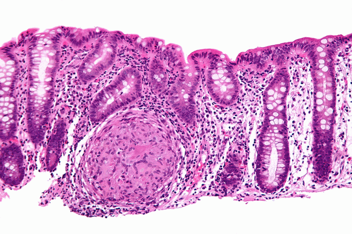 Read more about the article Νόσος Crohn