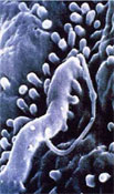 Το βακτηρίδιο του έλκους ενέχεται στην εμφάνιση αρτηριοσκλήρυνσης