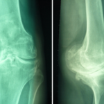 Άμεση βάδιση μετά από αντικατάσταση γόνατος, λόγω χρόνιας οστεοαρθρίτιδας