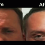 Νέα τεχνική botox αφαιρεί ρυτίδες χωρίς να αλλοιώνει τη φυσική έκφραση του προσώπου