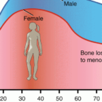 Γιατί η οστεοπόρωση προτιμά τις γυναίκες;