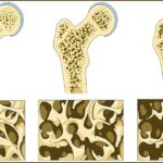Οστεοπόρωση: όλα όσα θέλετε να γνωρίζετε