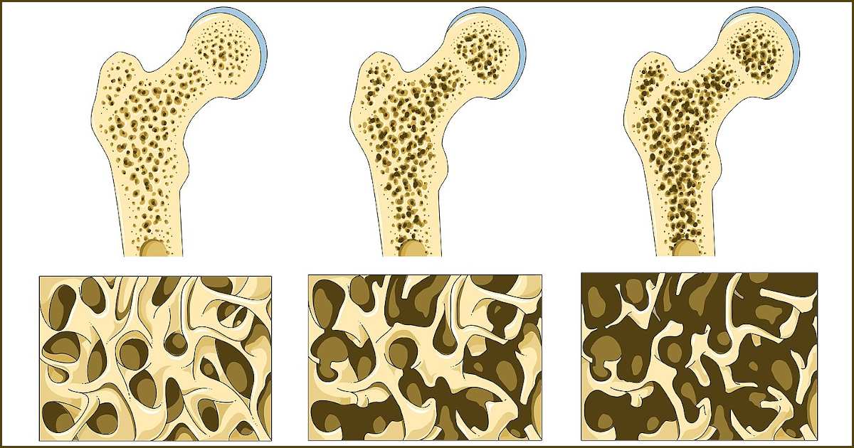 Read more about the article Οστεοπόρωση: όλα όσα θέλετε να γνωρίζετε